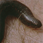 Leech Therapy